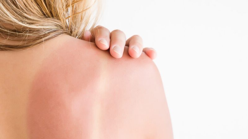 huidbescherming zon